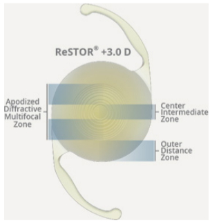 Restor +3.0 D
